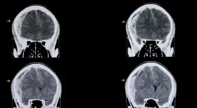 Head injury workers comp benefits NY