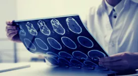 Post concussion syndrome from a car accident