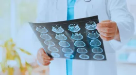 TBI after a NY car accident scan